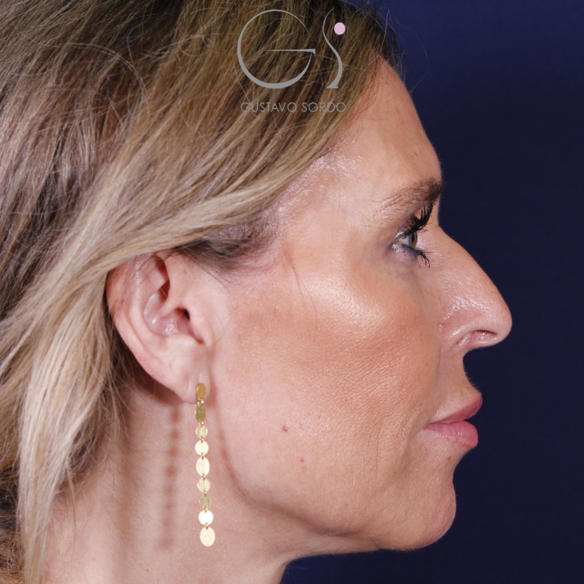 Rinoplastia — piel gruesa: antes y después de un caso operado por el Dr. Gustavo Sordo en Madrid