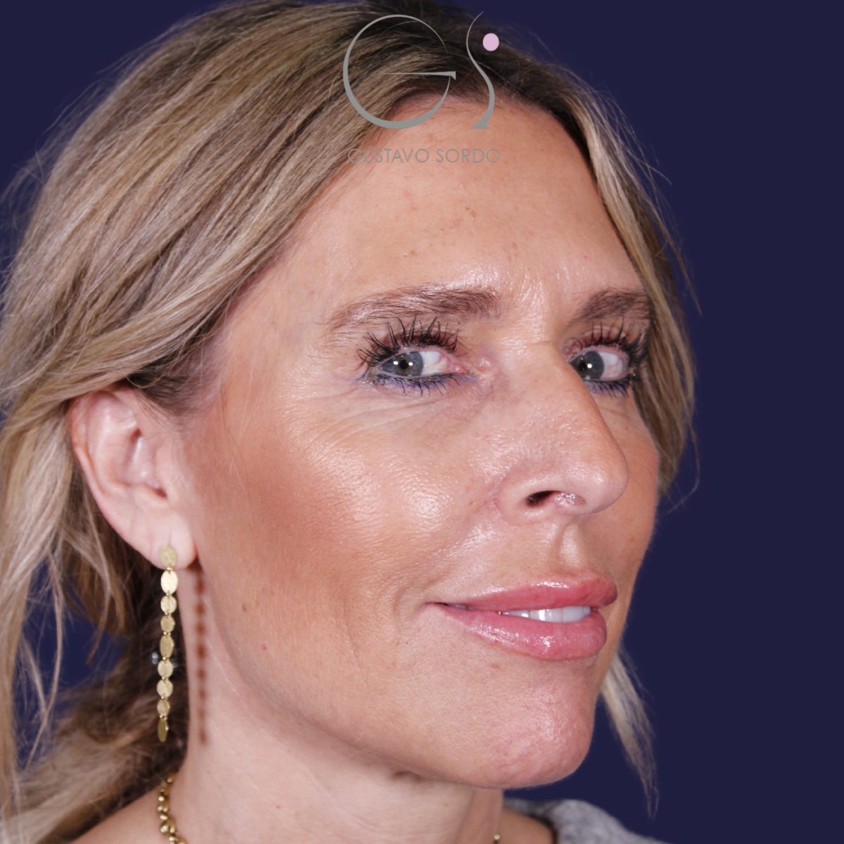 Rinoplastia — piel gruesa: antes y después de un caso operado por el Dr. Gustavo Sordo en Madrid