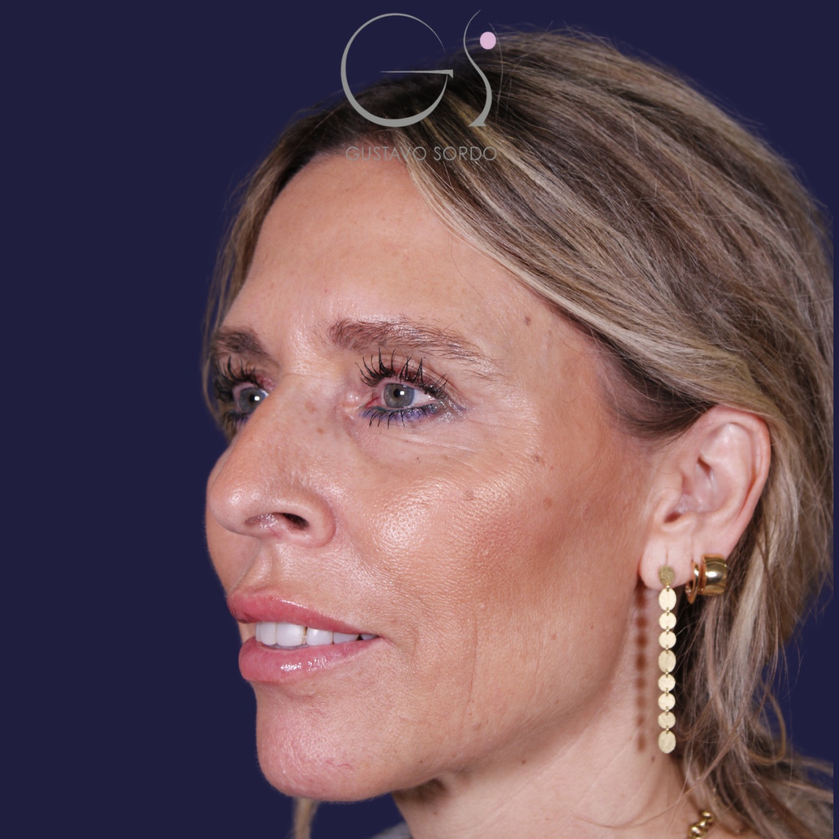Rinoplastia — piel gruesa: antes y después de un caso operado por el Dr. Gustavo Sordo en Madrid