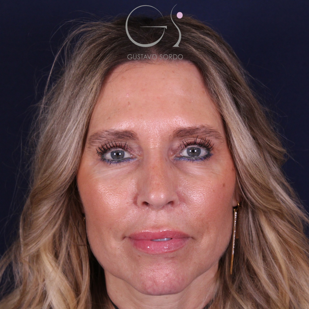 Rinoplastia — piel gruesa: antes y después de un caso operado por el Dr. Gustavo Sordo en Madrid