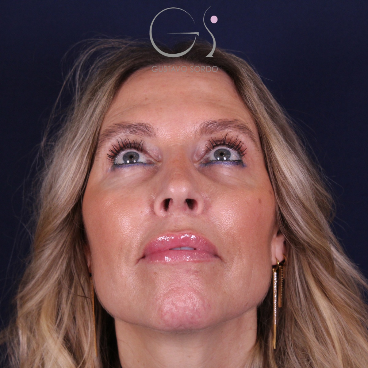 Rinoplastia — piel gruesa: antes y después de un caso operado por el Dr. Gustavo Sordo en Madrid