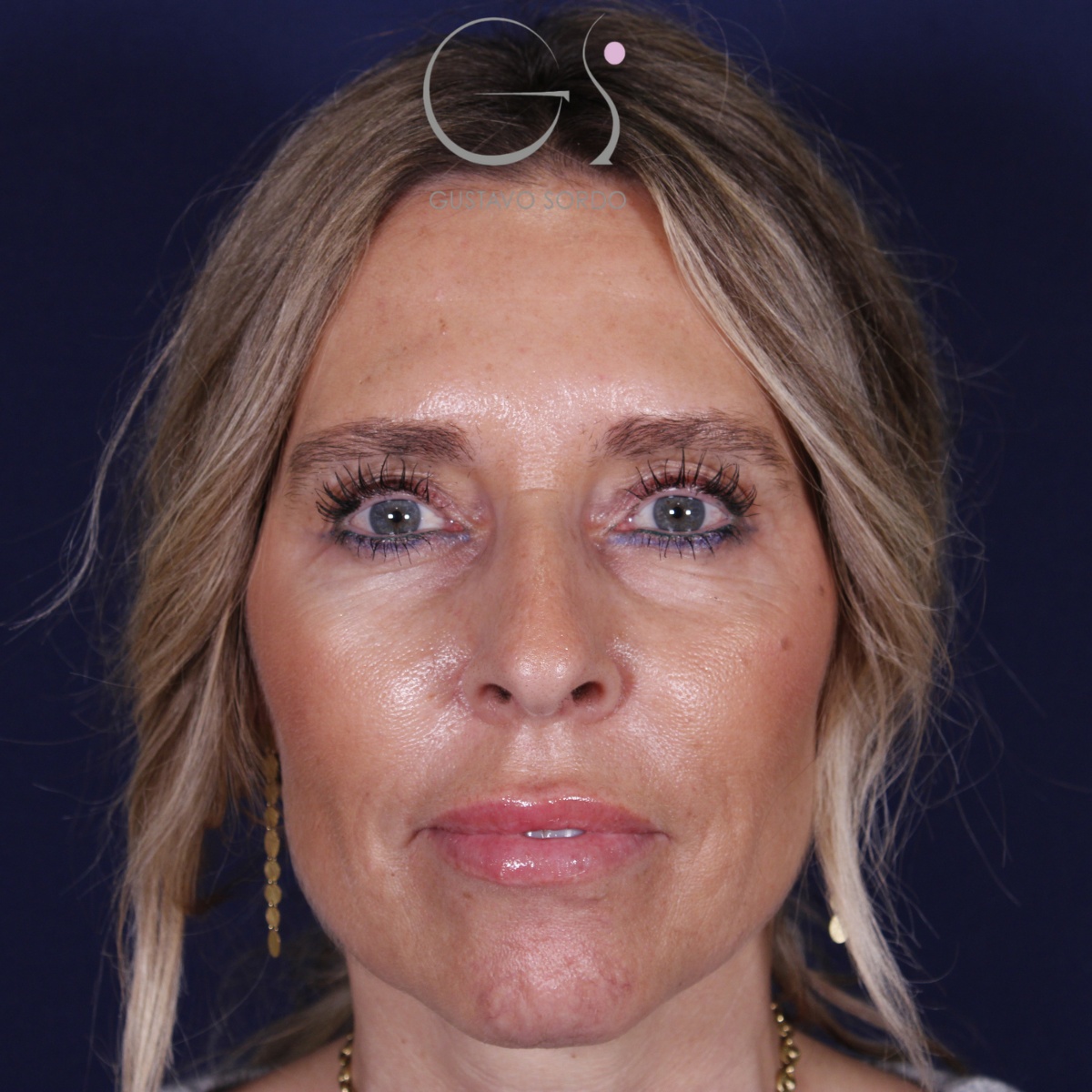 Rinoplastia — piel gruesa: antes y después de un caso operado por el Dr. Gustavo Sordo en Madrid