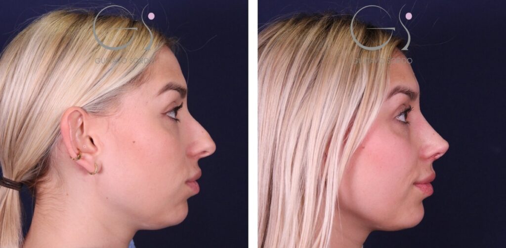 Rhinoplastie : avant et après une intervention réalisée à Madrid