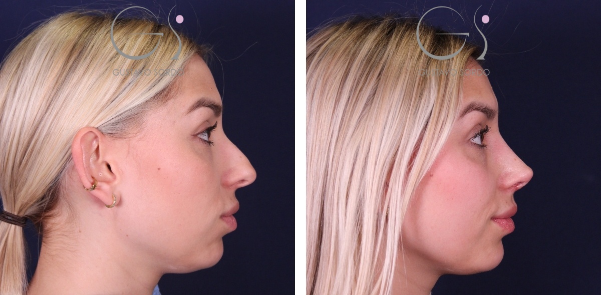 Rinoplastia ultrasónica de preservación: antes y después