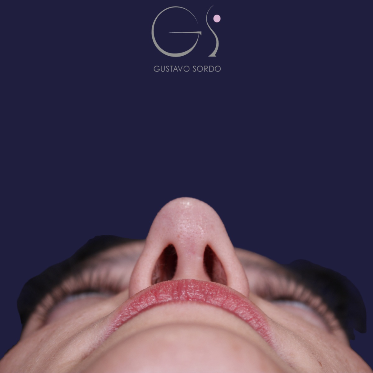 Rinoplastia: antes y después de un caso operado por el Dr. Gustavo Sordo en Madrid