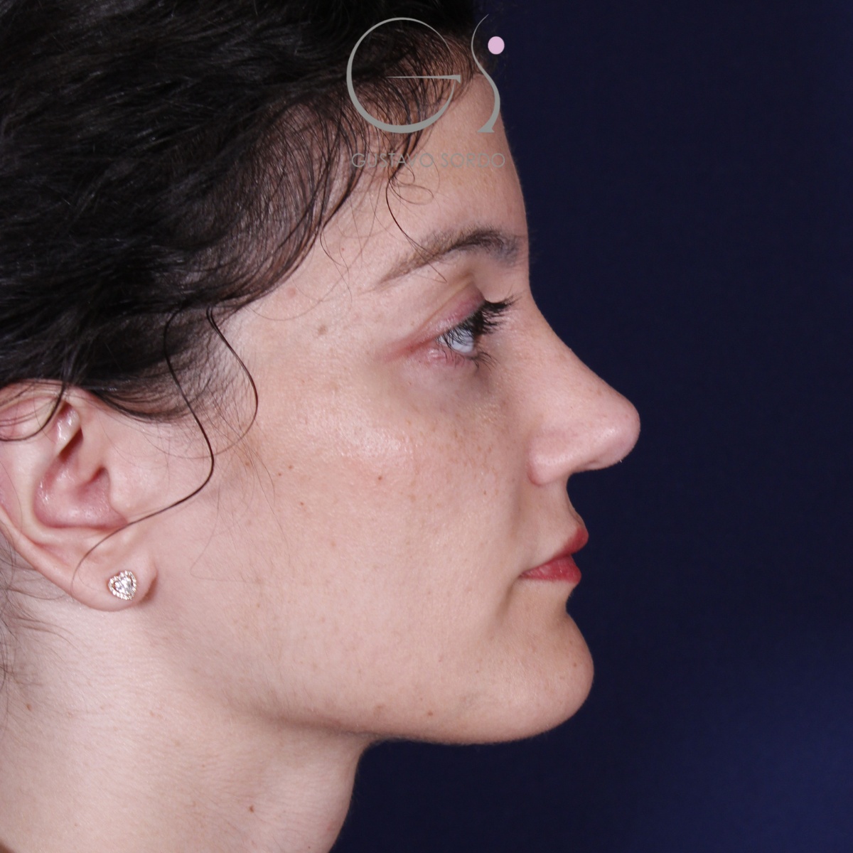 Rinoplastia: antes y después de un caso operado por el Dr. Gustavo Sordo en Madrid