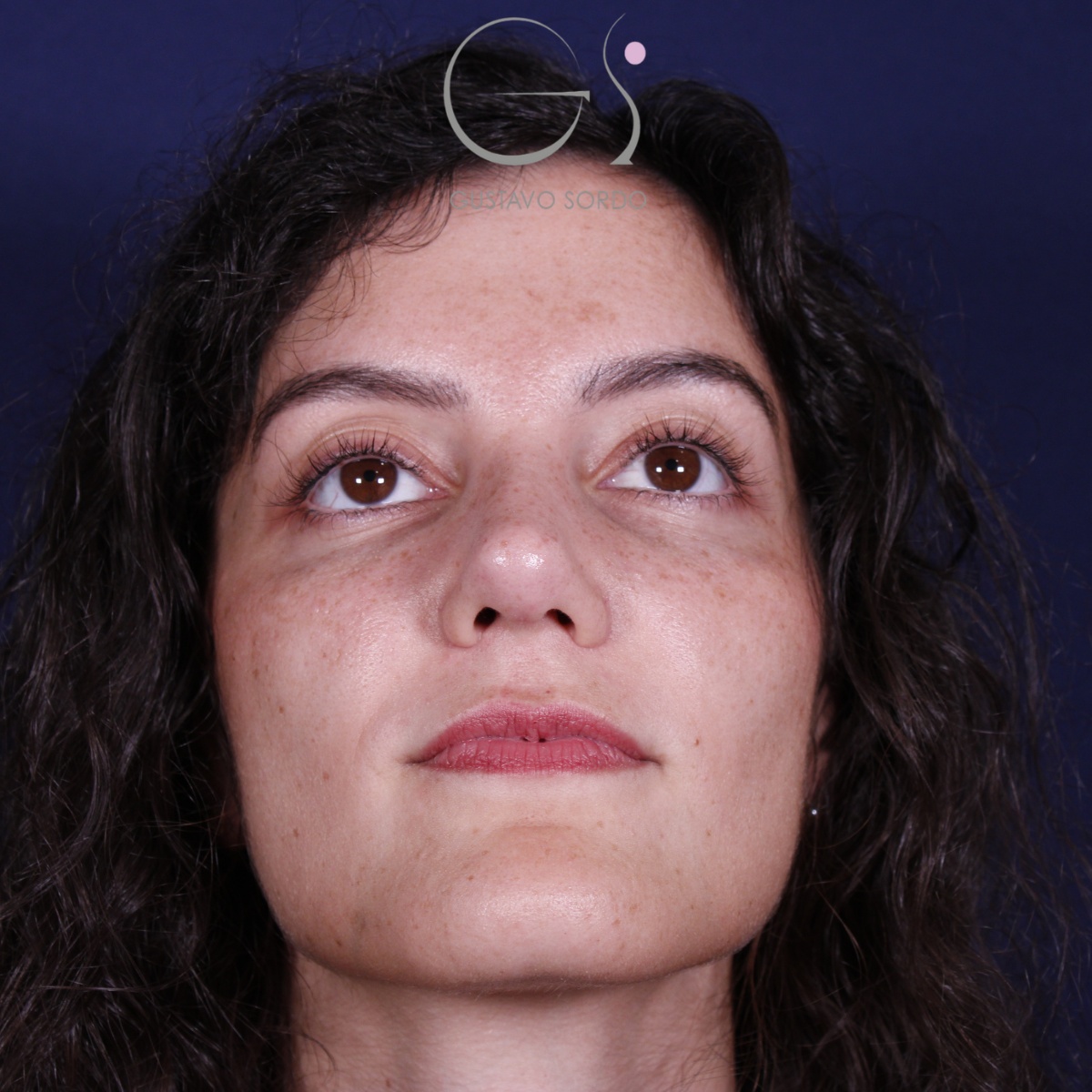 Rinoplastia: antes y después de un caso operado por el Dr. Gustavo Sordo en Madrid