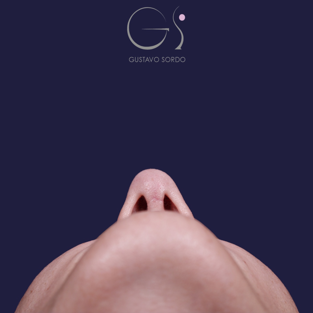 Rinoplastia — piel gruesa: antes y después de un caso operado por el Dr. Gustavo Sordo en Madrid