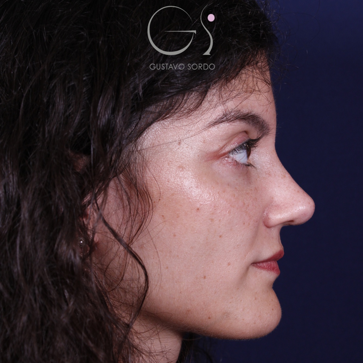 Rinoplastia: antes y después de un caso operado por el Dr. Gustavo Sordo en Madrid