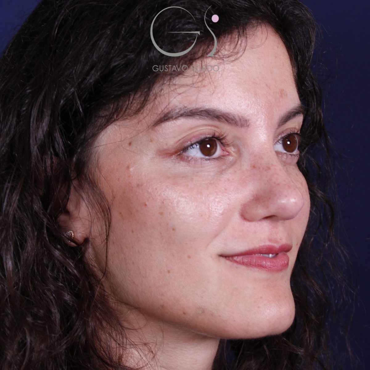 Rinoplastia: antes y después de un caso operado por el Dr. Gustavo Sordo en Madrid