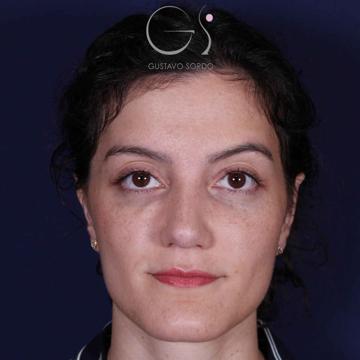 Rinoplastia: antes y después de un caso operado por el Dr. Gustavo Sordo en Madrid