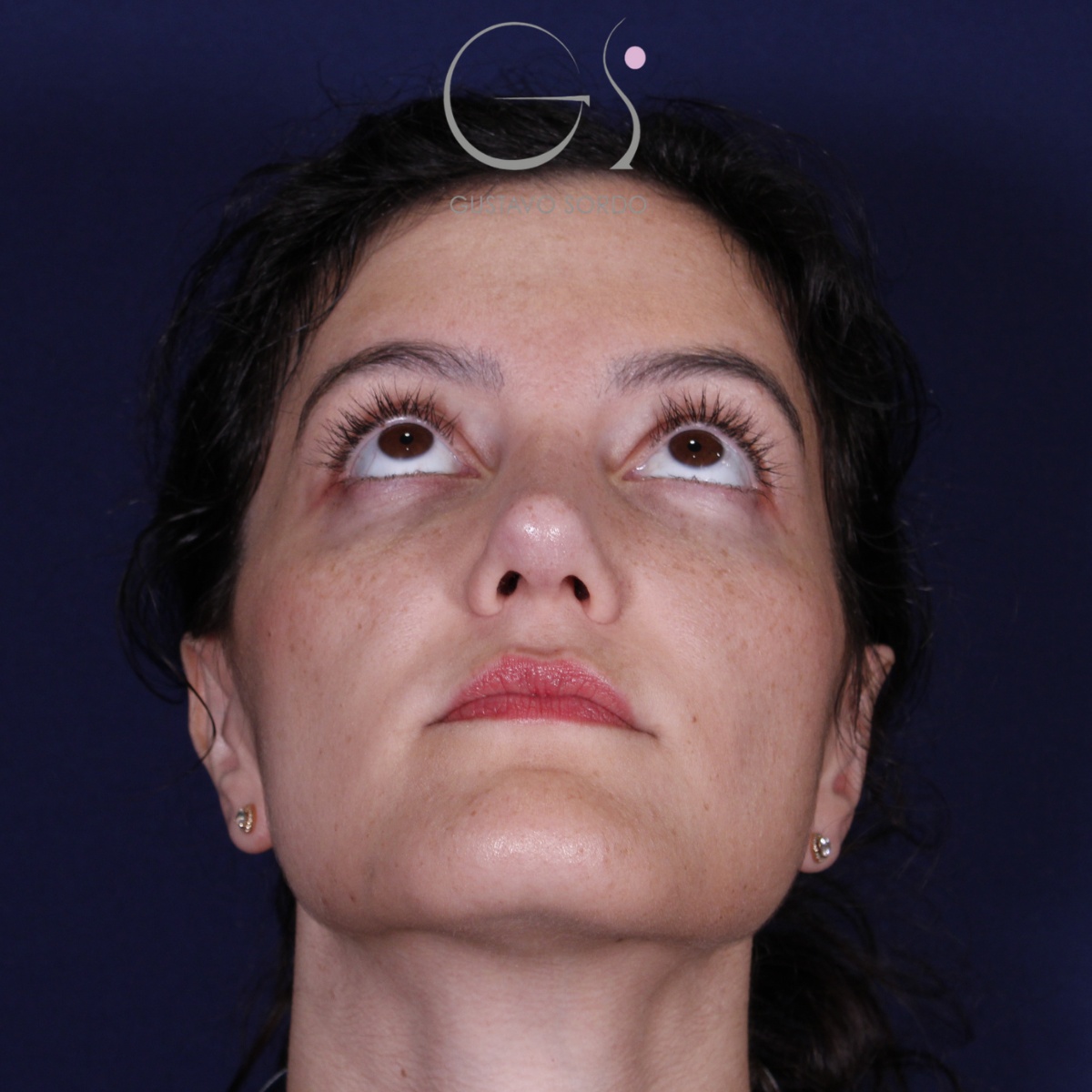 Rinoplastia: antes y después de un caso operado por el Dr. Gustavo Sordo en Madrid