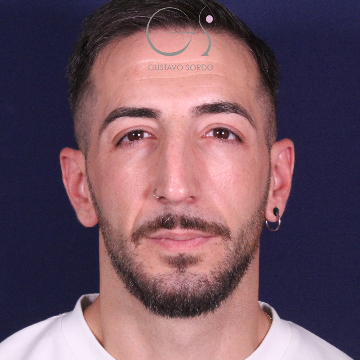 Rinoplastia ultrasónica en paciente con desviación nasal postraumática
