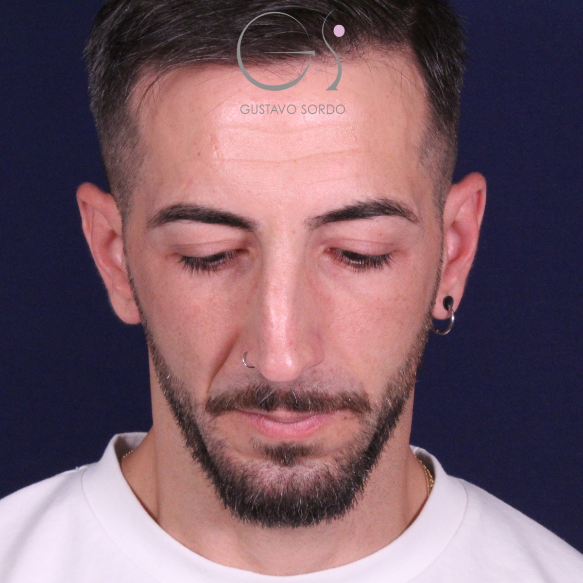 Rinoplastia ultrasónica en paciente con desviación nasal postraumática