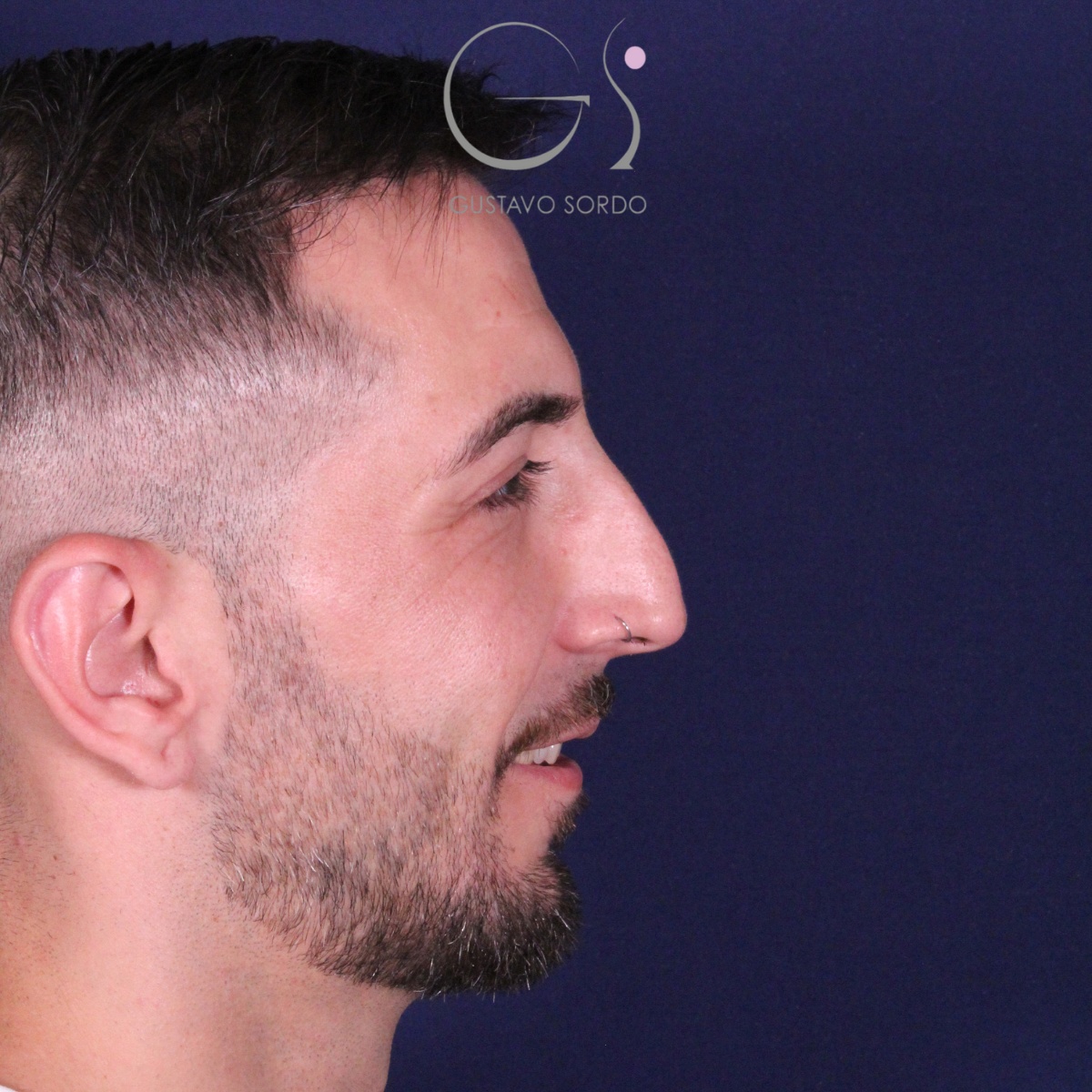 Rinoplastia ultrasónica en paciente con desviación nasal postraumática