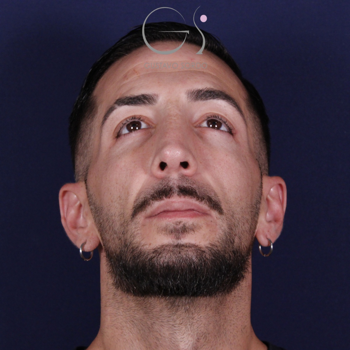 Rinoplastia ultrasónica en paciente con desviación nasal postraumática