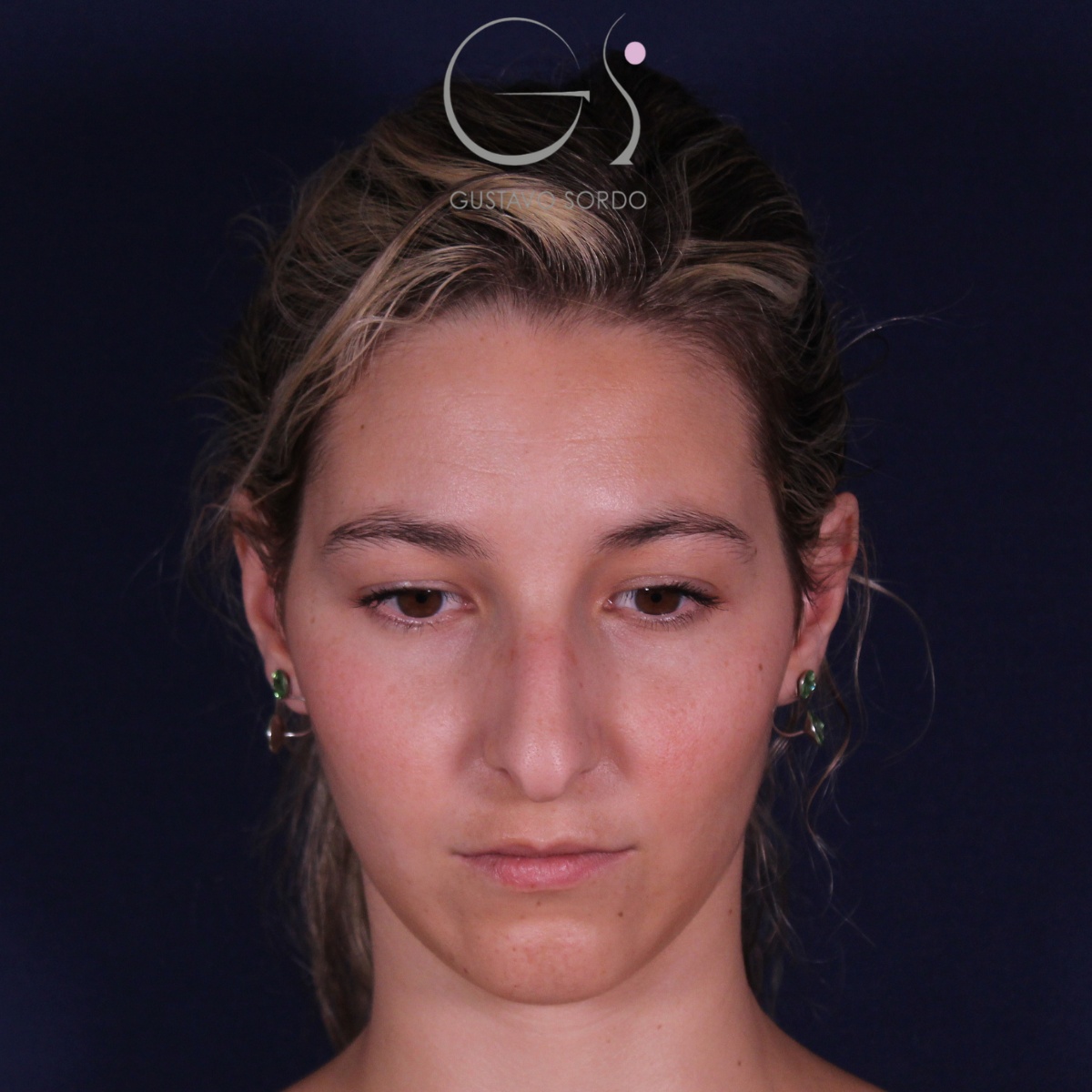 Rinoplastia: antes y después de un caso operado por el Dr. Gustavo Sordo en Madrid