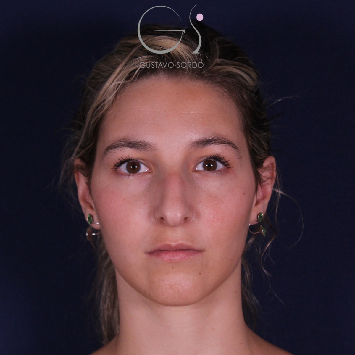 Rinoplastia: antes y después de un caso operado por el Dr. Gustavo Sordo en Madrid