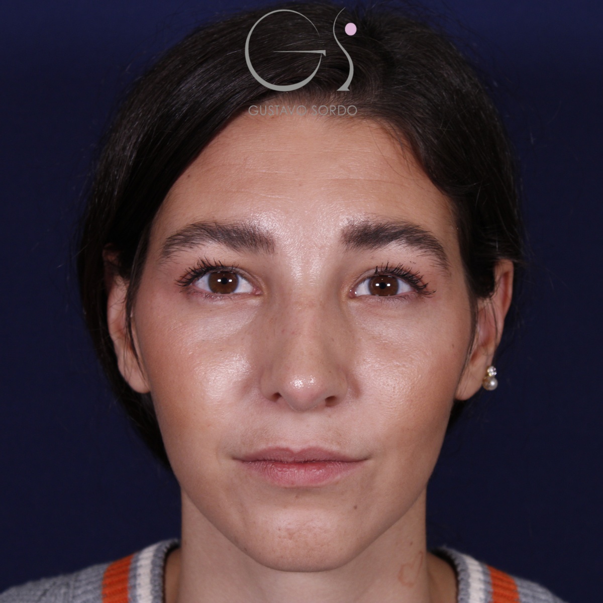 Rinoplastia: antes y después de un caso operado por el Dr. Gustavo Sordo en Madrid