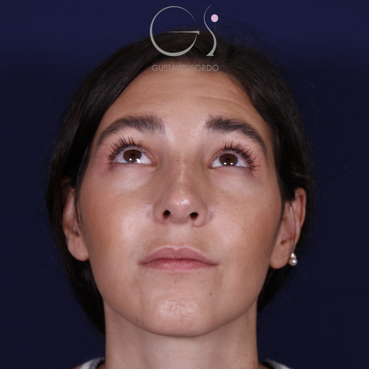 Rinoplastia: antes y después de un caso operado por el Dr. Gustavo Sordo en Madrid