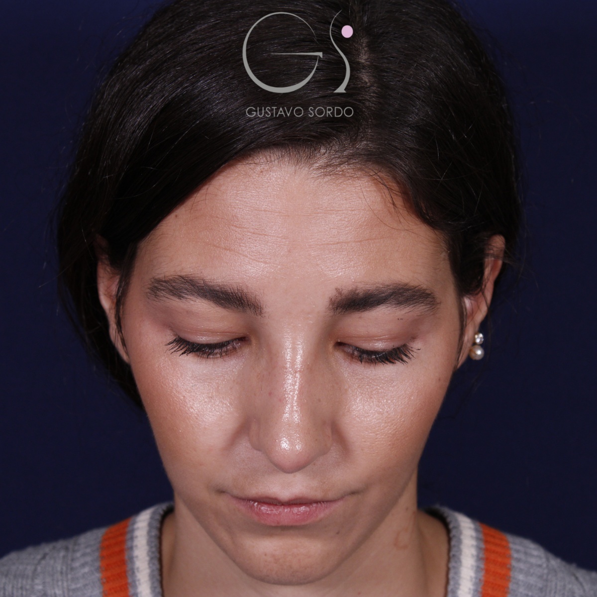 Rinoplastia: antes y después de un caso operado por el Dr. Gustavo Sordo en Madrid