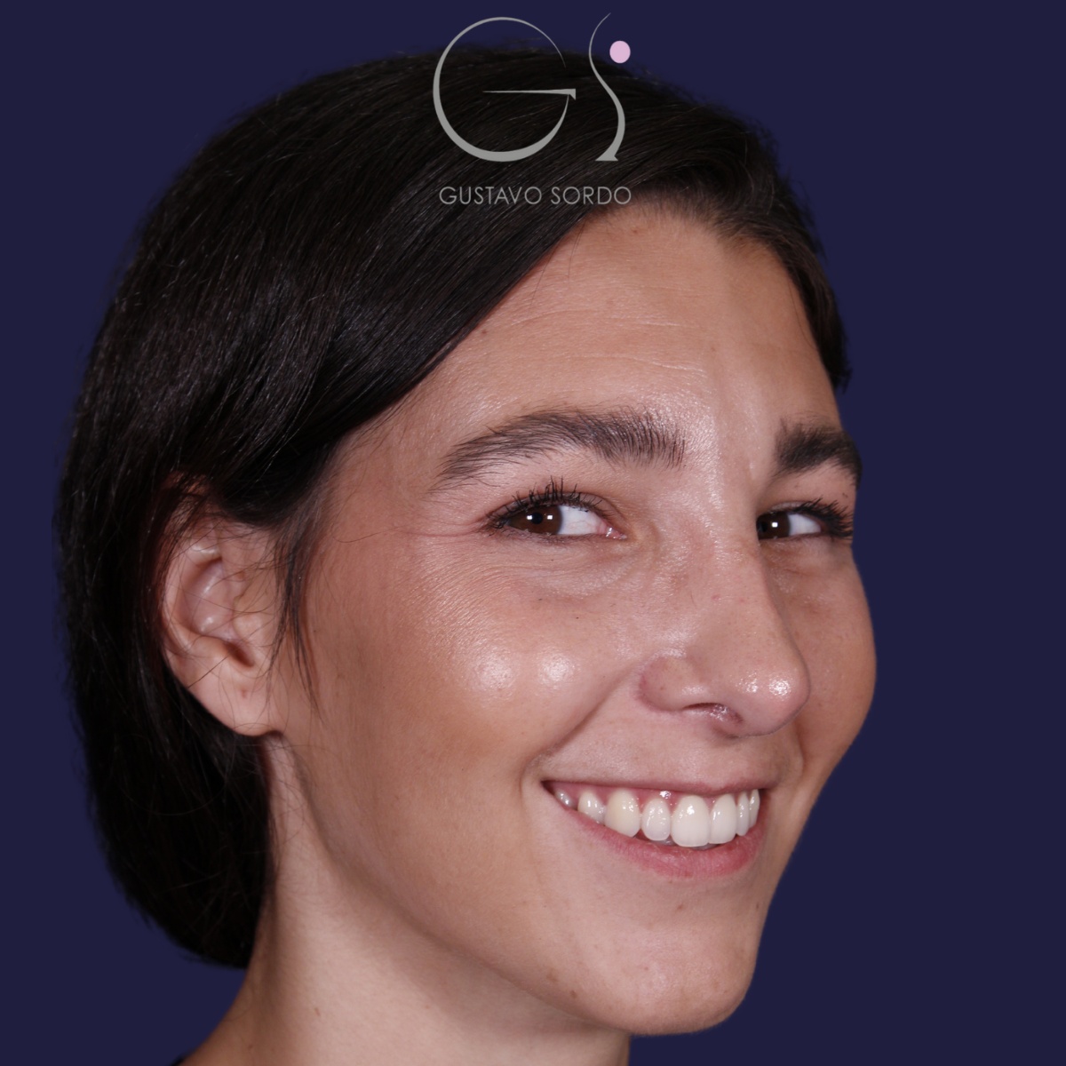 Rinoplastia: antes y después de un caso operado por el Dr. Gustavo Sordo en Madrid