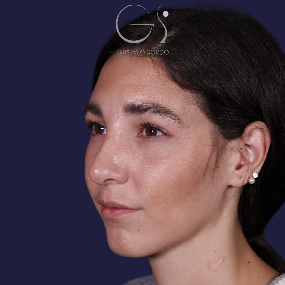 Rinoplastia: antes y después de un caso operado por el Dr. Gustavo Sordo en Madrid