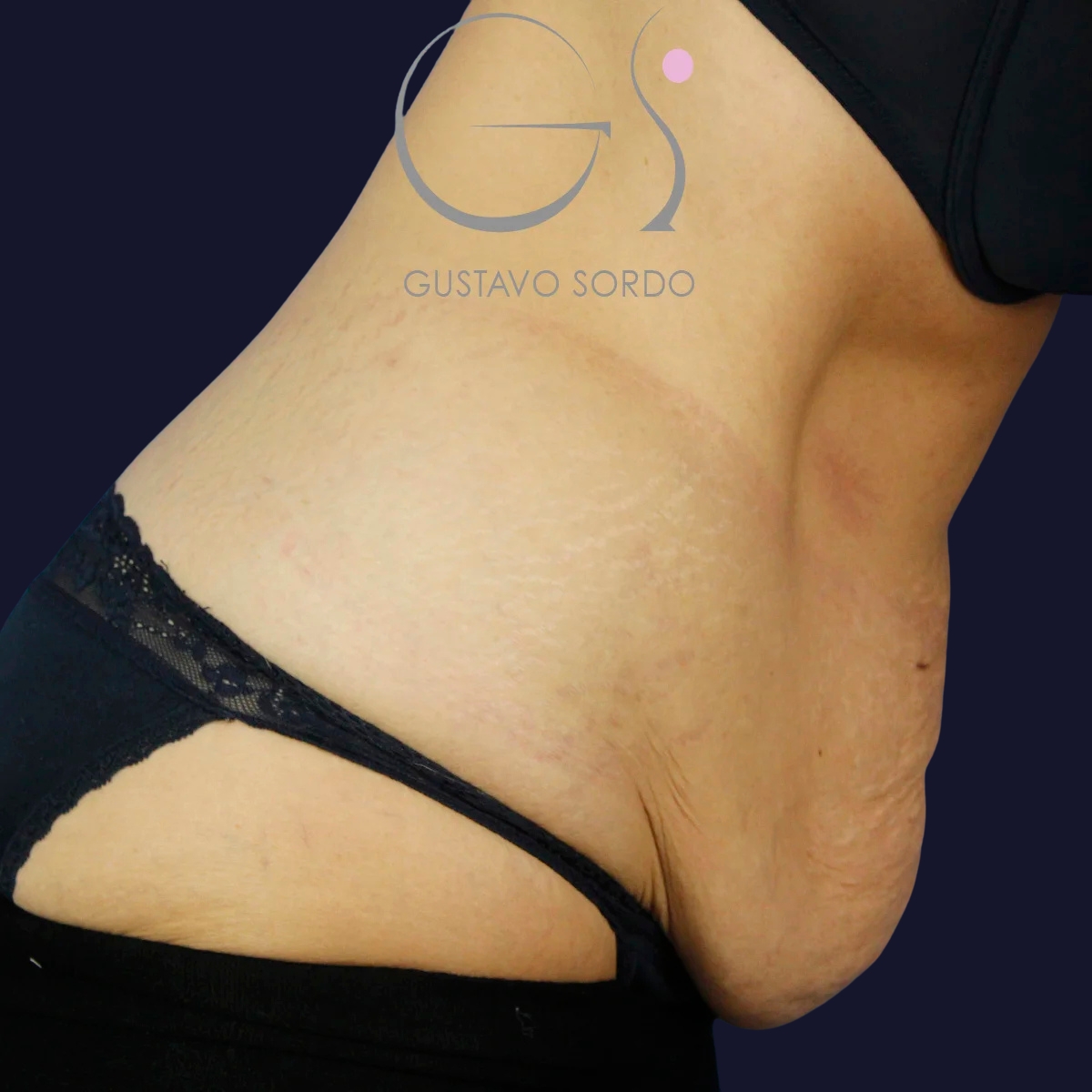 Abdominoplastia y liposucción en mujer, antes de la operación (2)