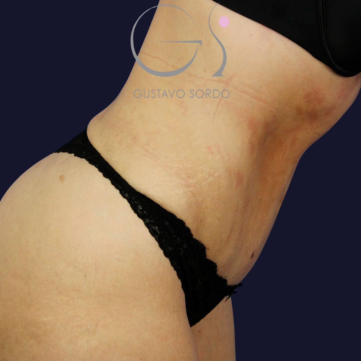 Abdominoplastia y liposucción en mujer, después de la operación (2)