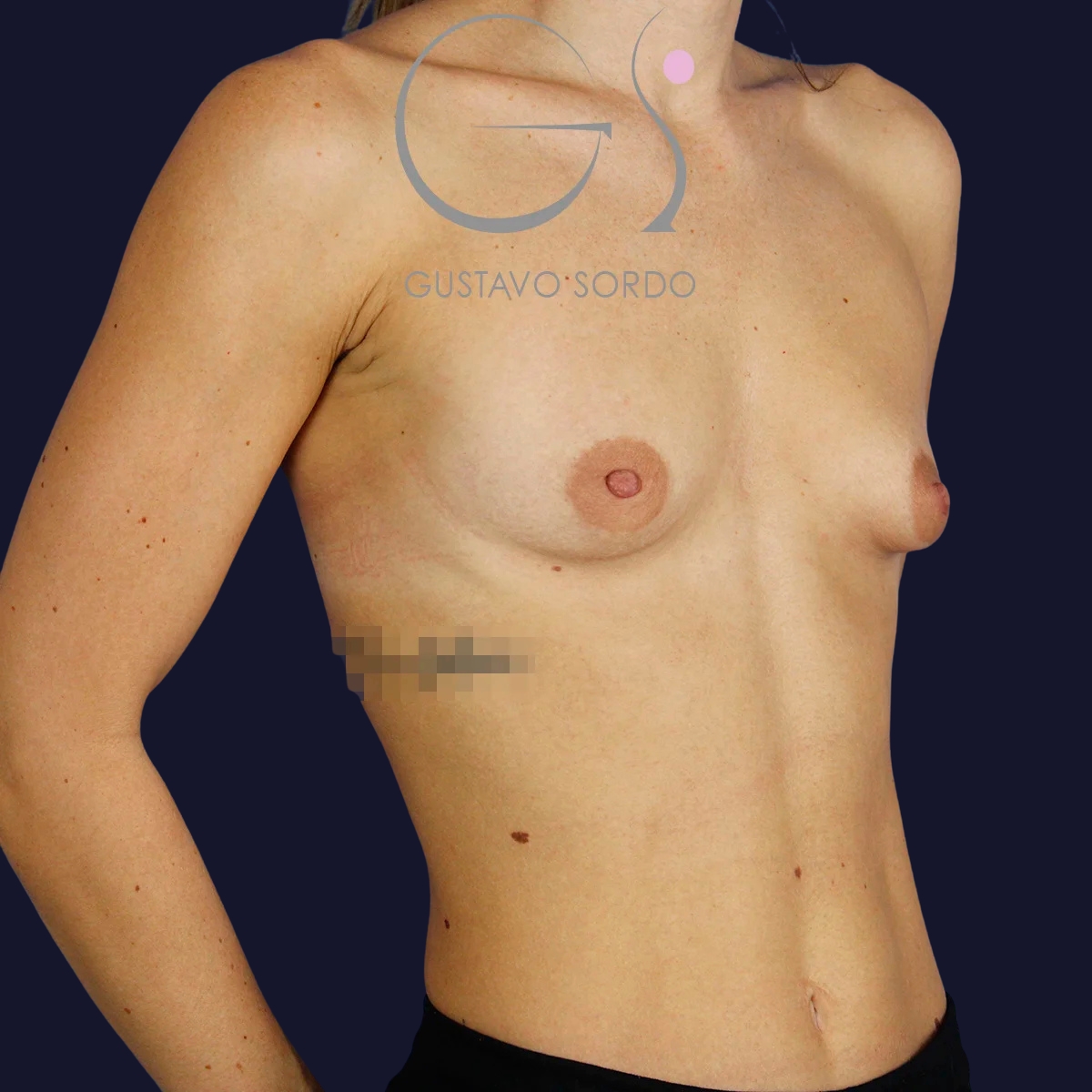 Antes de aumento de pecho con implantes anatómicos de 295cc, Dr. Gustavo Sordo