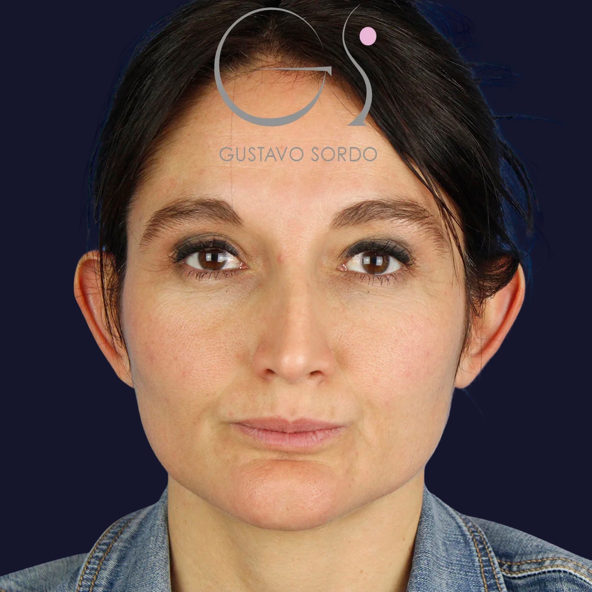 Resultado de una otoplastia en mujer, antes de la operación (1)
