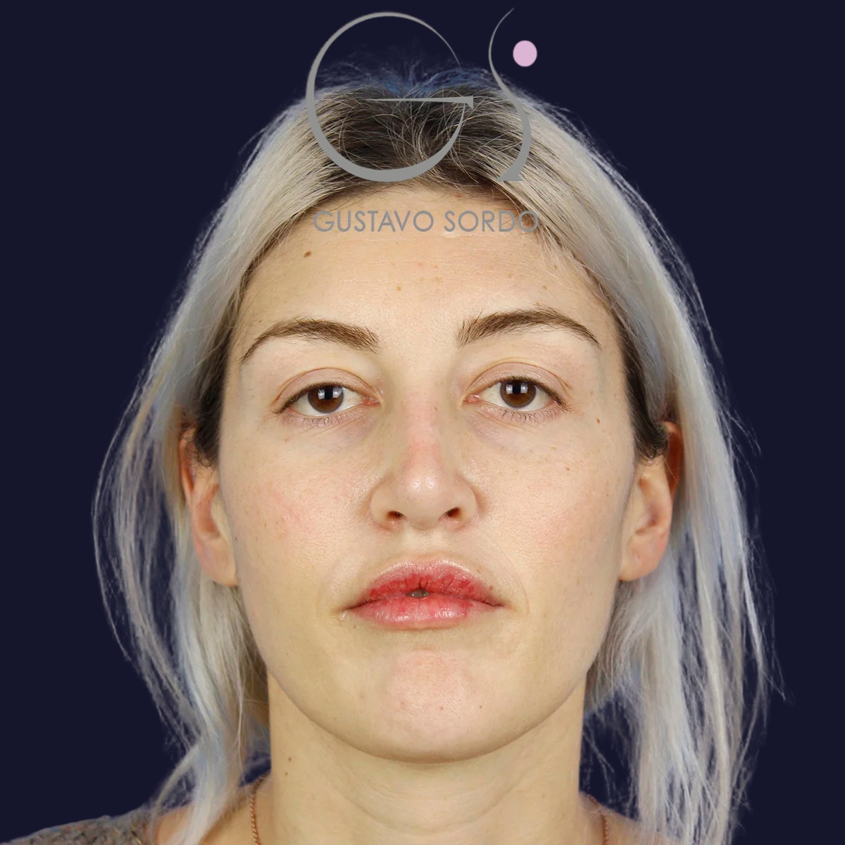 Rinoplastia y blefaroplastia superior, antes de la cirugía — caso operado por el Dr. Gustavo Sordo en Madrid (1)