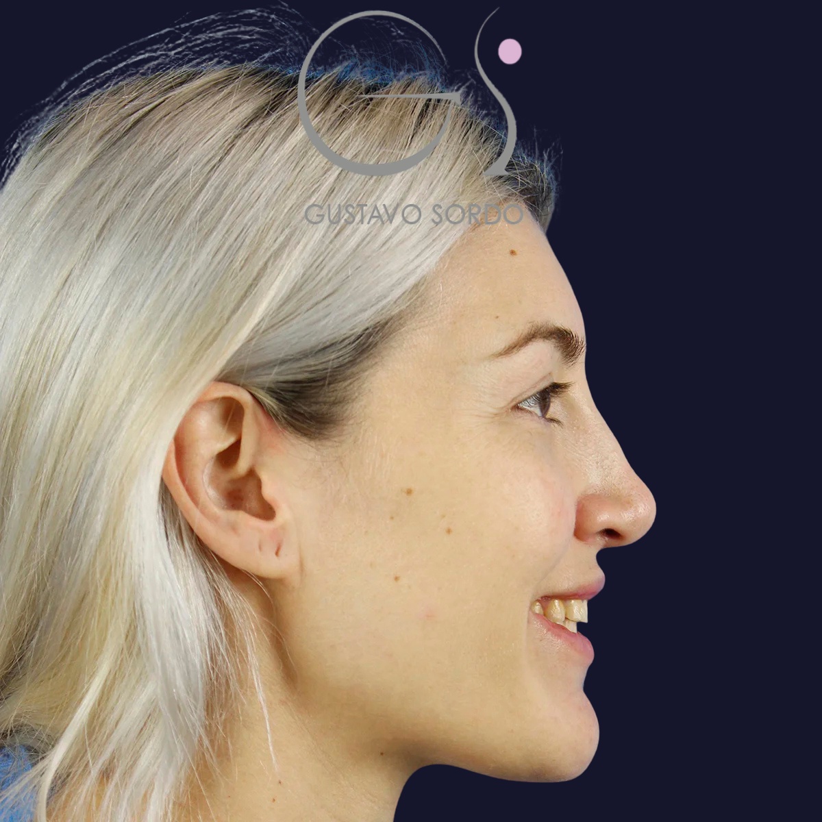 Rinoplastia y blefaroplastia superior, antes de la cirugía — caso operado por el Dr. Gustavo Sordo en Madrid (2)