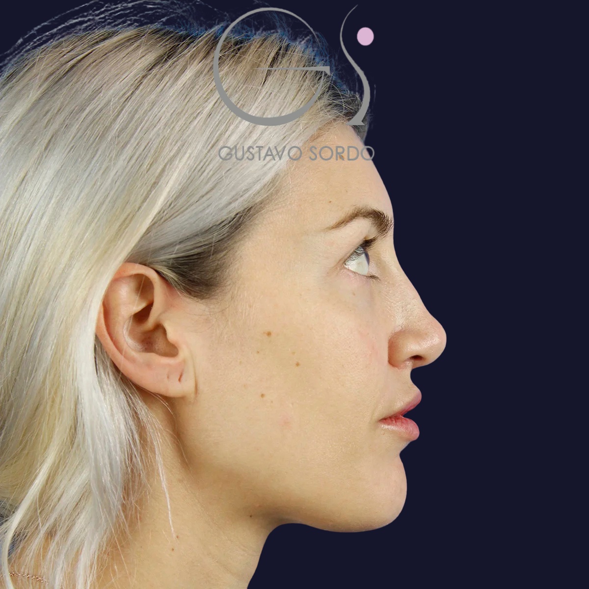 Rinoplastia y blefaroplastia superior, antes de la cirugía — caso operado por el Dr. Gustavo Sordo en Madrid (3)