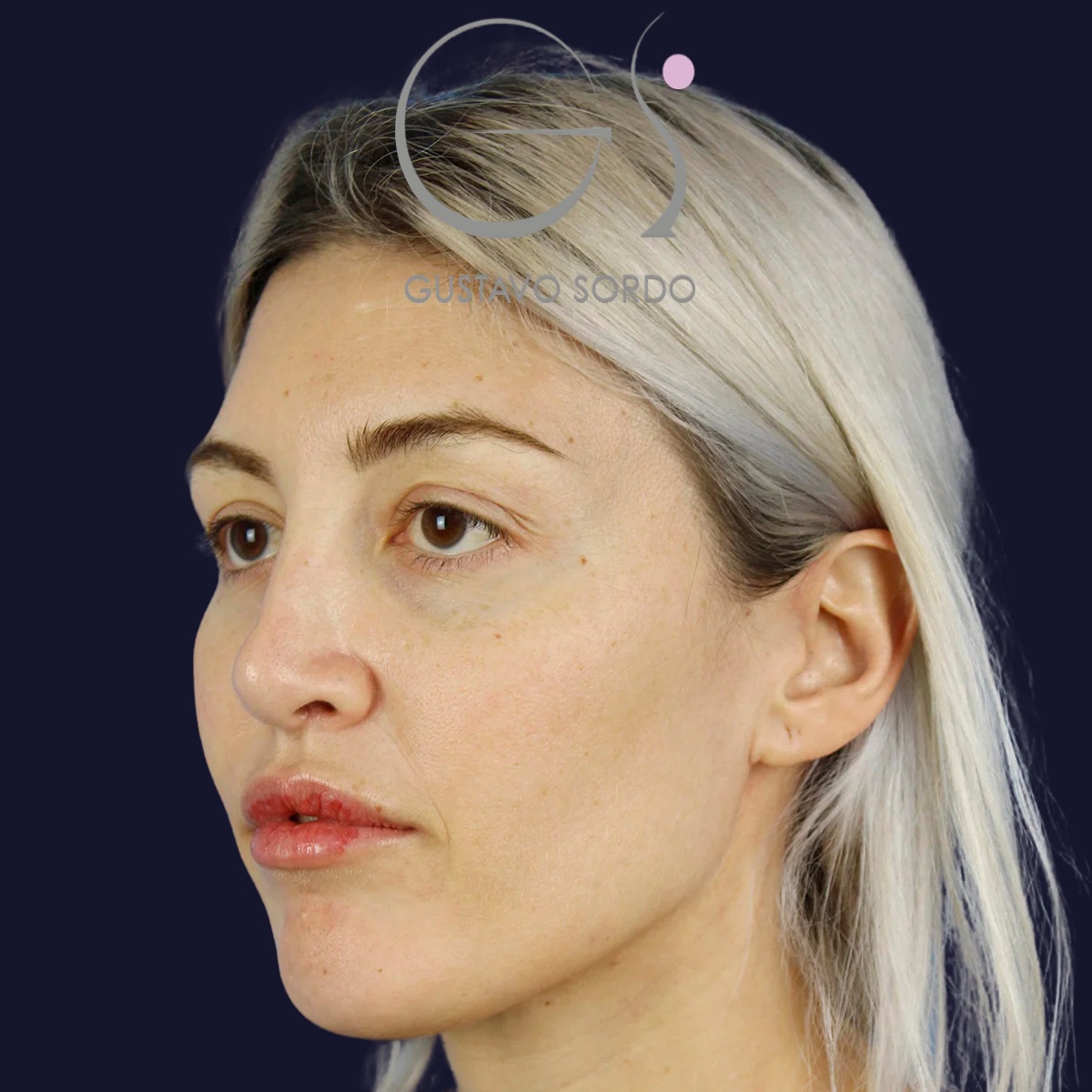 Rinoplastia y blefaroplastia superior, antes de la cirugía — caso operado por el Dr. Gustavo Sordo en Madrid (4)