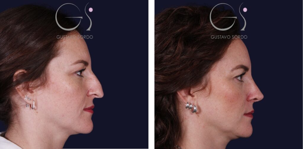 Rhinoplastie chez la femme : avant et après une intervention réalisée par le Dr Gustavo Sordo à Madrid