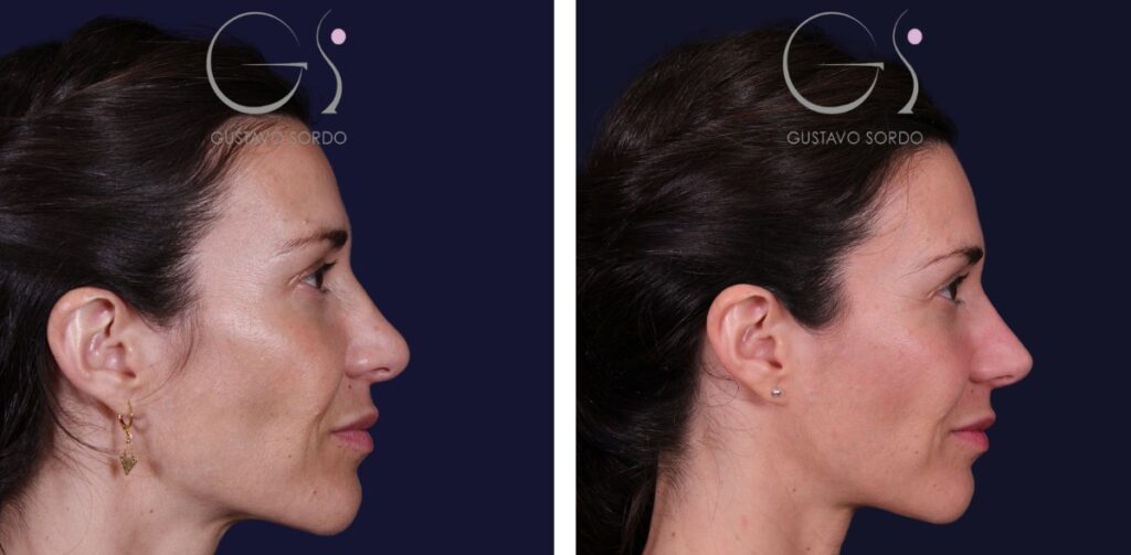 Rhinoplastie : avant et après une intervention réalisée à Madrid