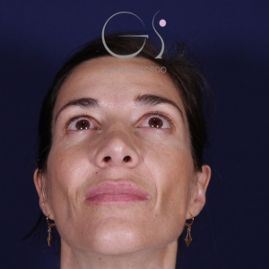 Rinoplastia mujer natural, antes de la cirugía — caso operado por el Dr. Gustavo Sordo en Madrid (3)