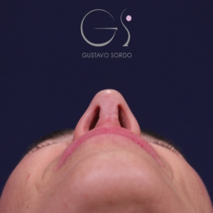 Rinoplastia mujer natural, resultado tras la cirugía — caso operado por el Dr. Gustavo Sordo en Madrid (4)