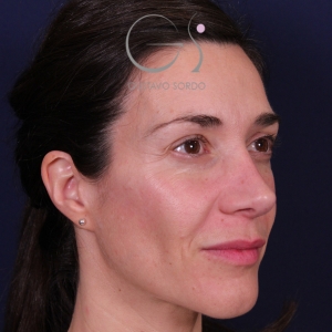 Rinoplastia mujer natural, resultado tras la cirugía — caso operado por el Dr. Gustavo Sordo en Madrid (6)