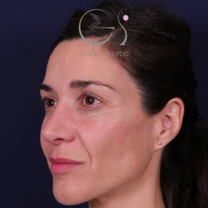 Rinoplastia mujer natural, resultado tras la cirugía — caso operado por el Dr. Gustavo Sordo en Madrid (7)