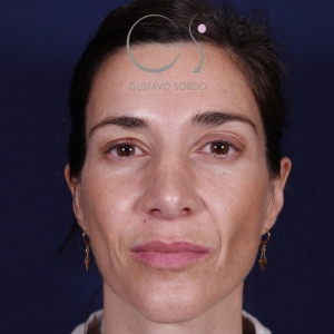 Rinoplastia mujer natural, antes de la cirugía — caso operado por el Dr. Gustavo Sordo en Madrid (1)