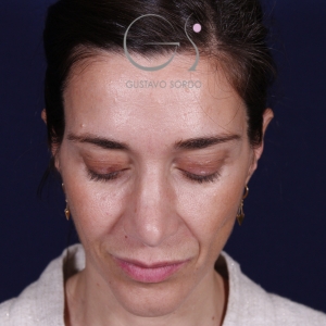 Rinoplastia mujer natural, antes de la cirugía — caso operado por el Dr. Gustavo Sordo en Madrid (2)