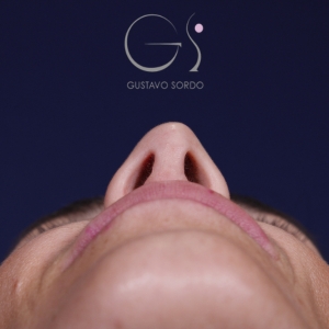 Rinoplastia mujer natural, antes de la cirugía — caso operado por el Dr. Gustavo Sordo en Madrid (4)