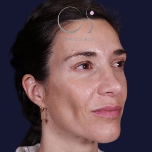 Rinoplastia mujer natural, antes de la cirugía — caso operado por el Dr. Gustavo Sordo en Madrid (6)
