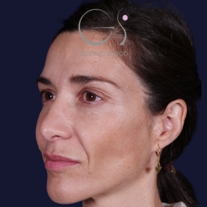 Rinoplastia mujer natural, antes de la cirugía — caso operado por el Dr. Gustavo Sordo en Madrid (7)