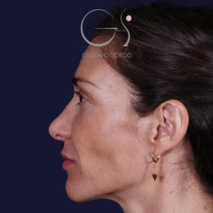 Rinoplastia mujer natural, antes de la cirugía — caso operado por el Dr. Gustavo Sordo en Madrid (8)