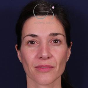 Rinoplastia mujer natural, resultado tras la cirugía — caso operado por el Dr. Gustavo Sordo en Madrid (1)