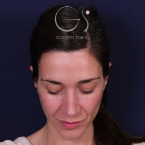 Rinoplastia mujer natural, resultado tras la cirugía — caso operado por el Dr. Gustavo Sordo en Madrid (2)