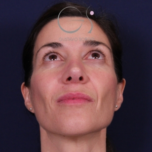 Rinoplastia mujer natural, resultado tras la cirugía — caso operado por el Dr. Gustavo Sordo en Madrid (3)